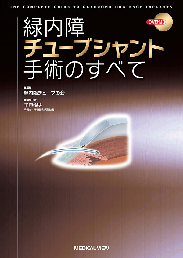 緑内障チューブシャント手術のすべて