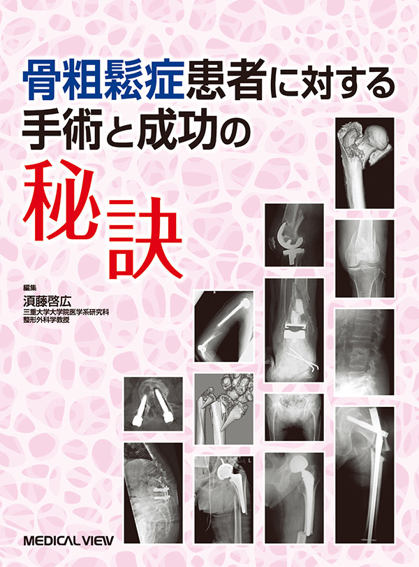 骨粗鬆症患者に対する手術と成功の秘訣